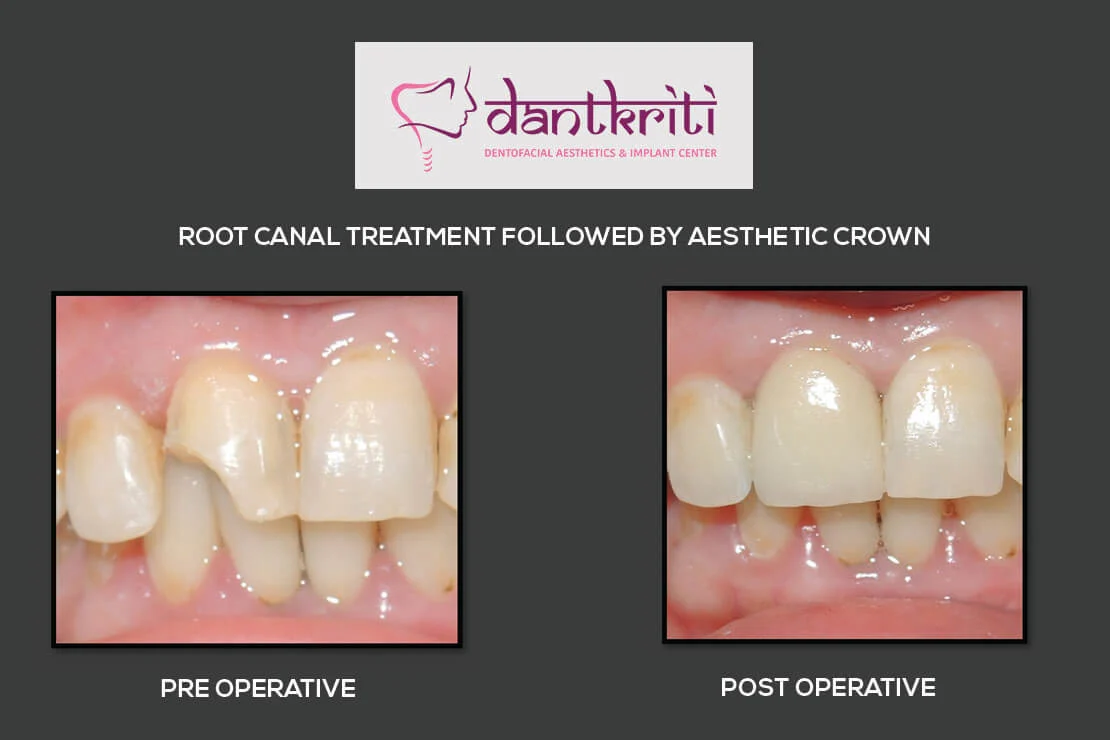 full dental implant cost gurgaon