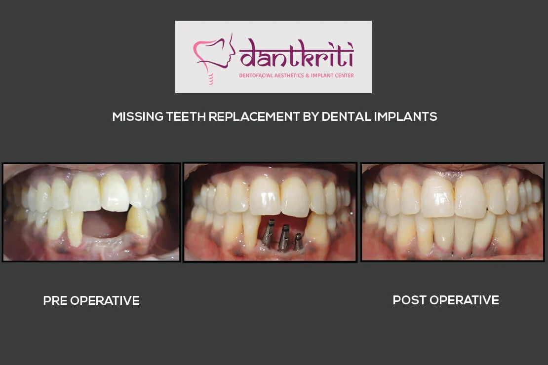 All on 6 Dental Implant specialist gurgaon