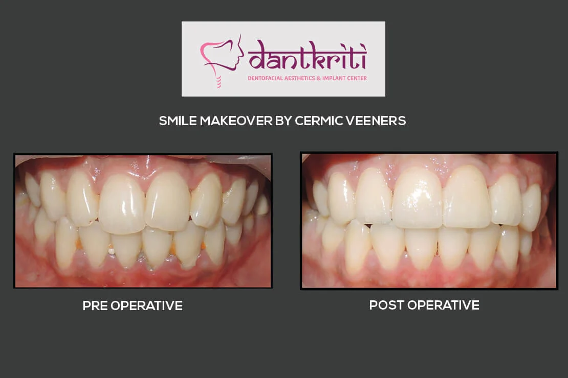 All on 6 Dental Implant specialist Doctor gurgaon