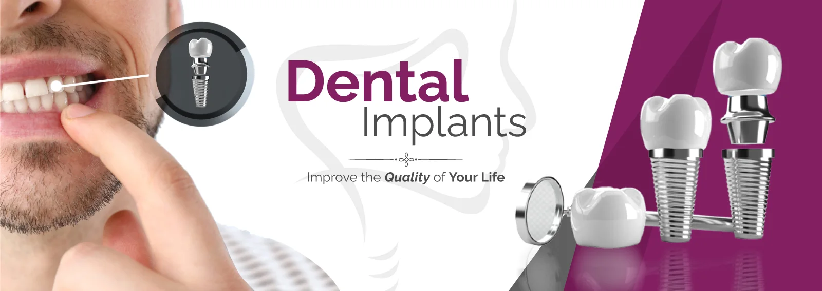 ceramic teeth cap price gurgaon